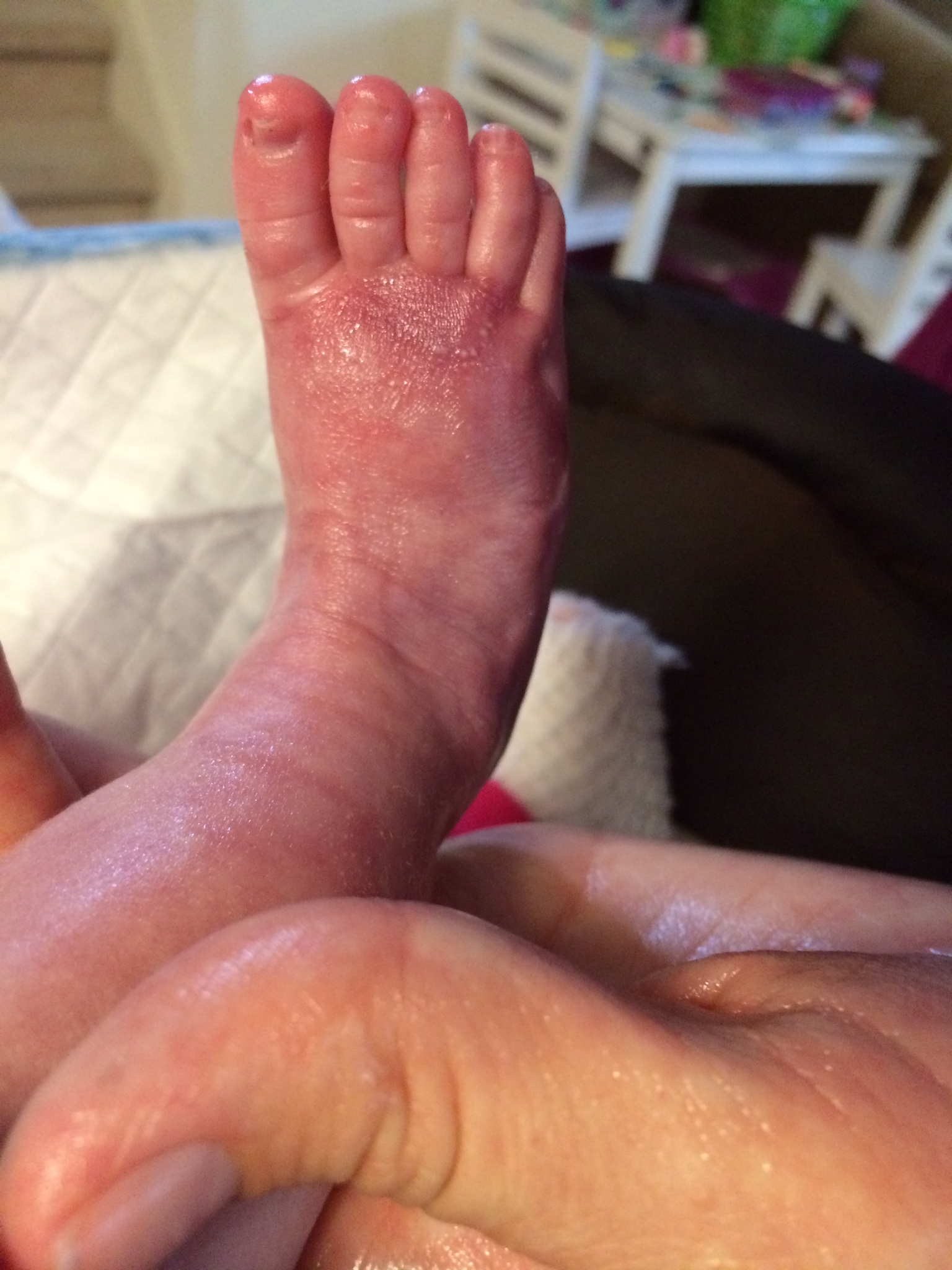 Kiira's healing right foot at 6 weeks